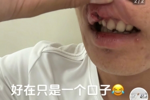 玉昆后卫晒受伤照：提前换下因争头球撞到了 视野模糊看不清&amp;头晕